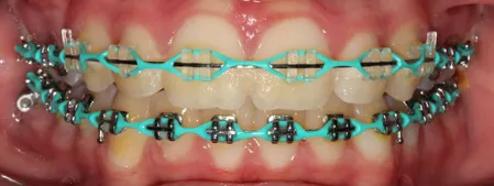 👶🏻🔵Baby blue braces colors after 6 weeks in the mouth. Click the ➕ , navy blue braces after 6 weeks