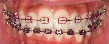 purple and teal braces