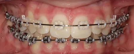 clear braces with purple bands