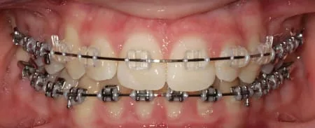Clear Modules on Full Orthodontics