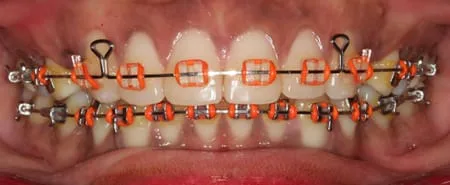 Orange colour braces. 