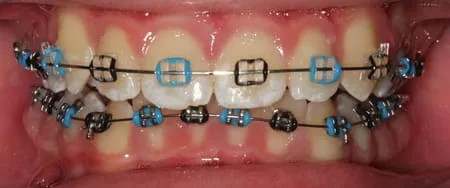 blue colored braces