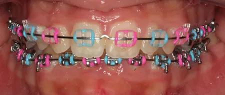 red colored braces