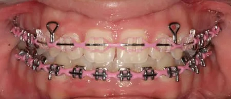 👶🏻🔵Baby blue braces colors after 6 weeks in the mouth. Click the ➕ , navy blue braces after 6 weeks