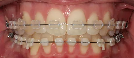 👶🏻🔵Baby blue braces colors after 6 weeks in the mouth. Click the ➕ , navy blue braces after 6 weeks