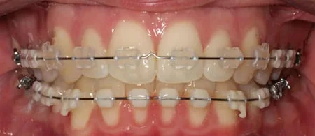 Clear Modules on 6 Month Smiles