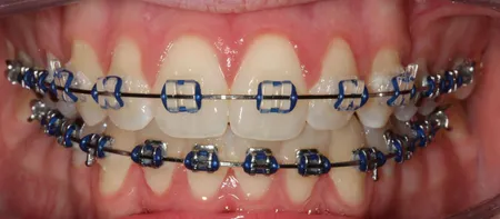 blue colored braces