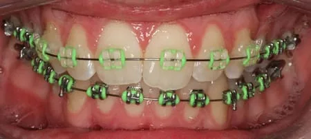 Lime Green Coloured Modules for Braces