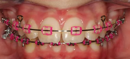 clear braces with purple bands