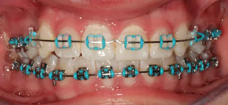 Light Blue Braces For You  Light blue braces, Braces colors, Braces teeth  colors