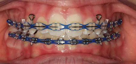 What the Rubber Band Color on Your Braces Means l Super Braces