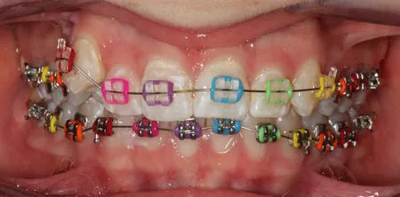 red colored braces