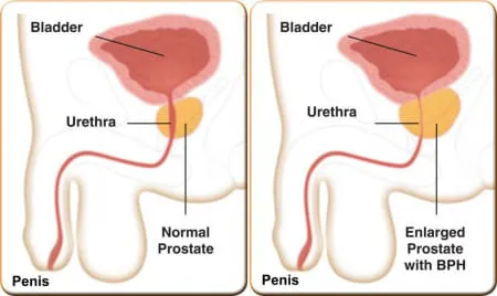 Urinary Flow Test  Steinberg Urology