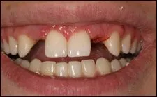 mouth with two missing teeth on either side of front teeth, before getting dental implants Spokane, WA