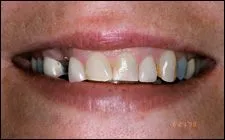 close up of person's mouth with discolored teeth, needs cosmetic dentistry Spokane, WA