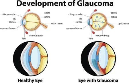 optimized-glaucoma-dev.jpg