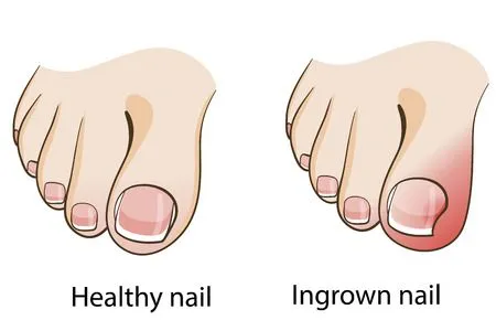 Ingrown toenails