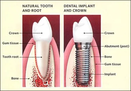 Dental Implants in Douglasville, GA