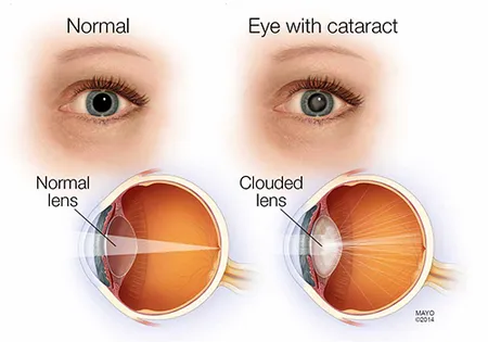 Eye with and without cataracts