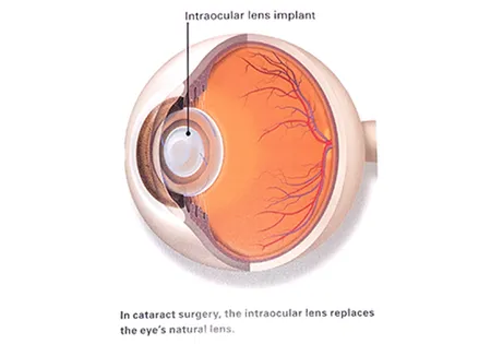 Diagram of lens implant