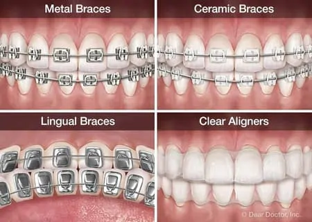 Ceramic Braces vs. Metal Braces: Nikaeen Orthoodontic