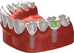 dental implant diagram