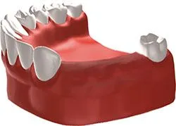 Missing teeth before dental implants