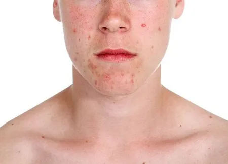 Acne - Center of Dermatology, P.C. - Omaha, NE