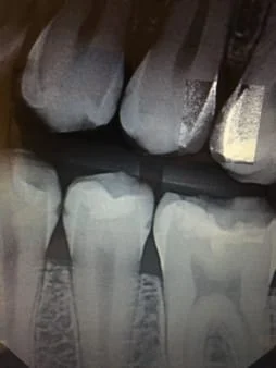 Decay Between the Teeth on Digital Dental Radiographs