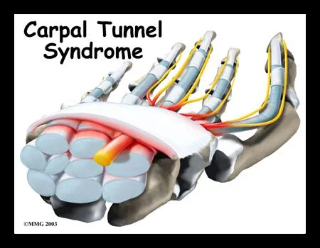 CARPAL TUNNEL 1