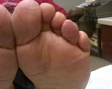 Left Foot After Crossover Toe Surgery Case 3