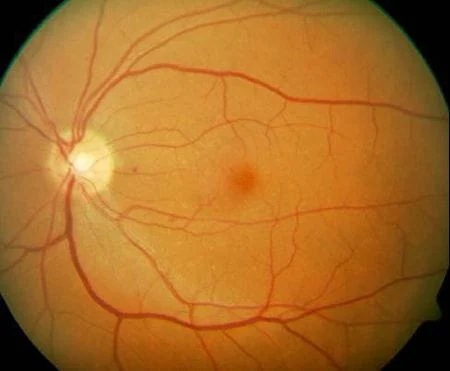 Results of Fundus photography