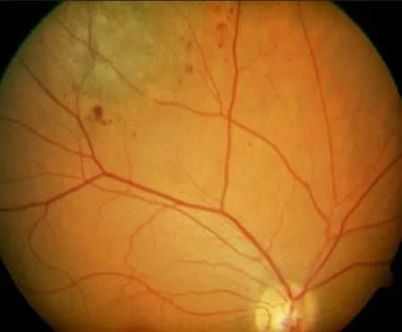Results of Fundus photography