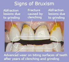 Signs of
Bruxism