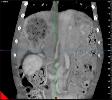 Abdominal CT