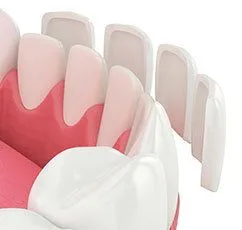 illustration of lower teeth, loose veneer pieces in front about to be placed, cosmetic dentistry Greenacres, FL dentist Lake Worth, FL