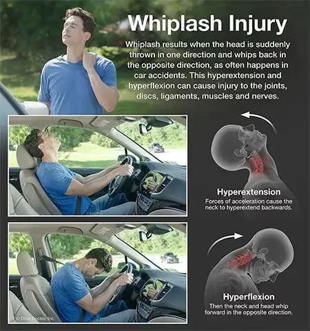 Whiplash Injury