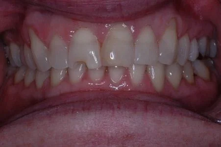 Before: Four front porcelain veneers to whiten and improve smile.