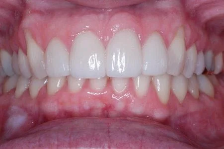 After: Four front porcelain veneers to whiten and improve smile.