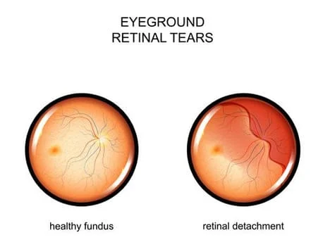 Retinal Tear Diagram