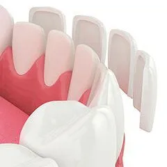 3D illustration of lower teeth and gums, veneer pieces floating in front of teeth about to be placed, veneers North York, ON dentist