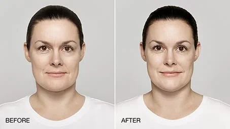 38 year old female treated with restylane Lyft
