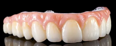 dental implant temporary acrylic bridge