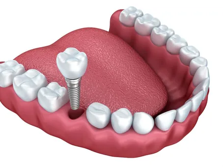 dental-implant.jpg