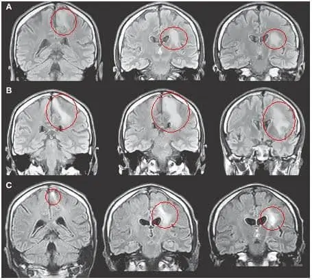 MRIofCeliacmimicsALS.jpg