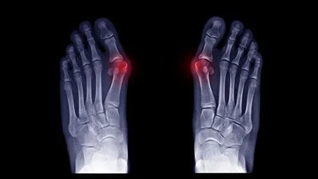 Toe Joint Nerve Disorders