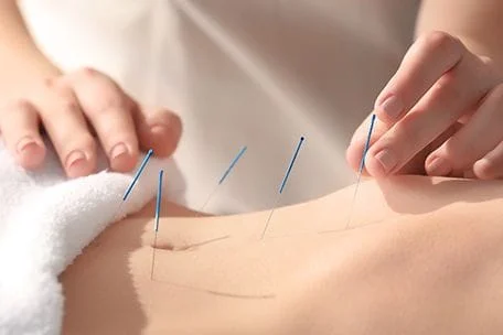 What is Acupuncture?
