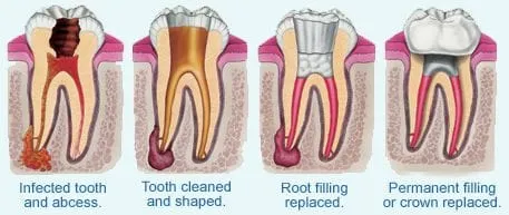 Root canal treatment in Guelph, ON