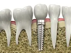 Implant1