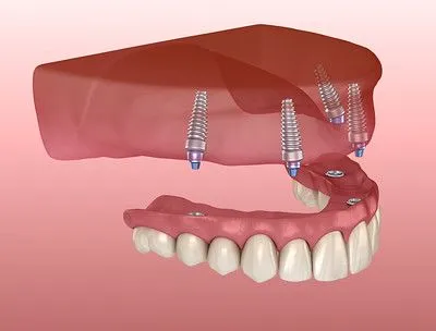 implant-supported denture